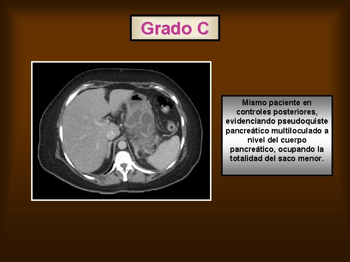 Grado C Mismo paciente en controles posteriores, evidenciando pseudoquiste pancreático multiloculado a nivel del