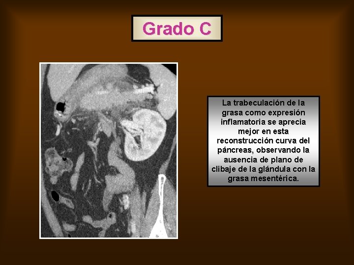 Grado C La trabeculación de la grasa como expresión inflamatoria se aprecia mejor en