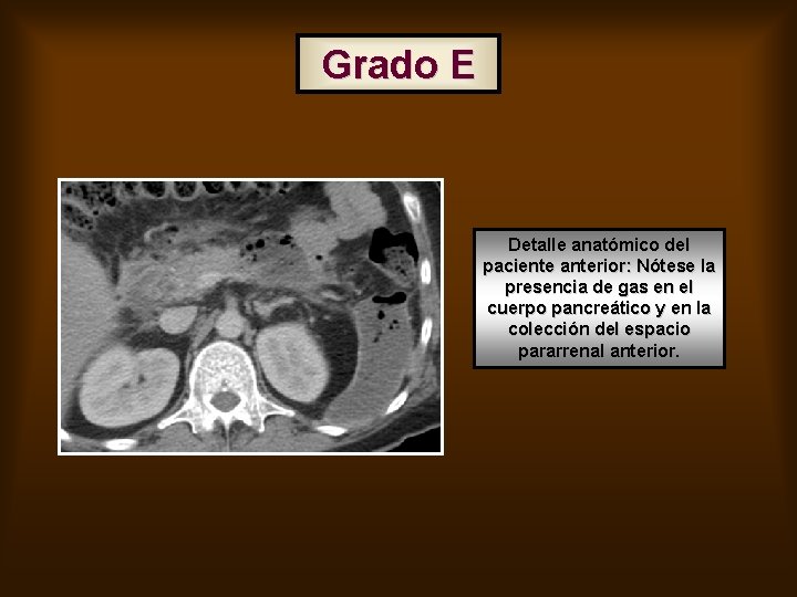 Grado E Detalle anatómico del paciente anterior: Nótese la presencia de gas en el