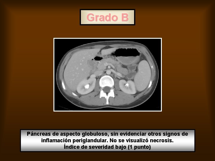 Grado B Páncreas de aspecto globuloso, sin evidenciar otros signos de inflamación periglandular. No