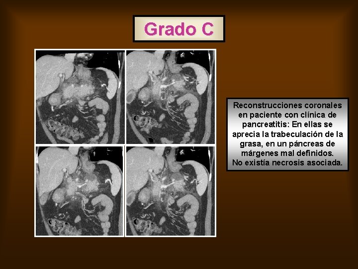 Grado C Reconstrucciones coronales en paciente con clínica de pancreatitis: En ellas se aprecia