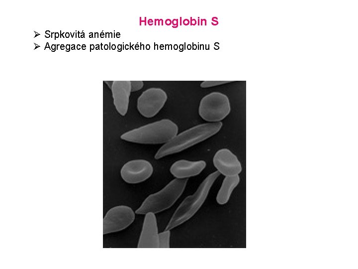Hemoglobin S Ø Srpkovitá anémie Ø Agregace patologického hemoglobinu S 