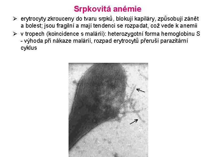 Srpkovitá anémie Ø erytrocyty zkrouceny do tvaru srpků, blokují kapiláry, způsobují zánět a bolest;