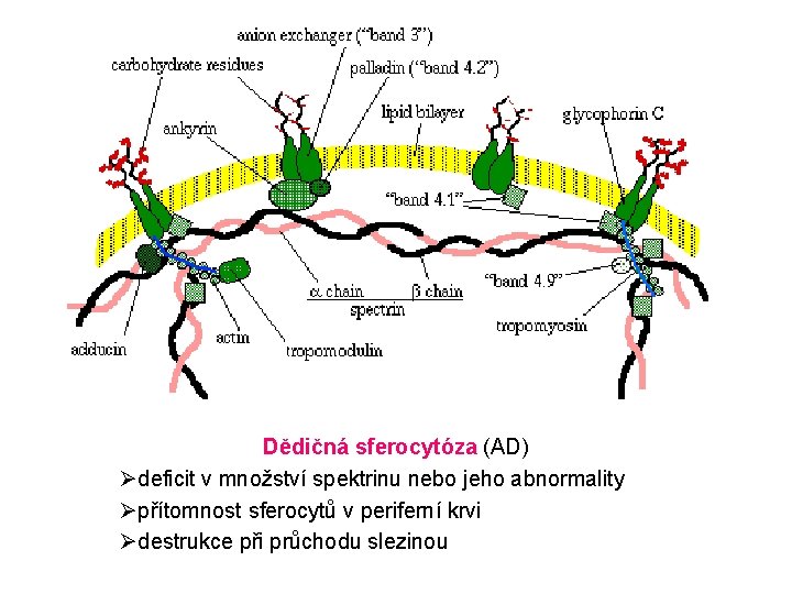 Dědičná sferocytóza (AD) Ødeficit v množství spektrinu nebo jeho abnormality Øpřítomnost sferocytů v periferní