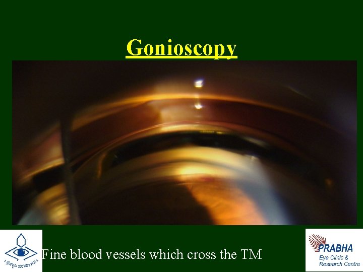 Gonioscopy • Fine blood vessels which cross the TM 
