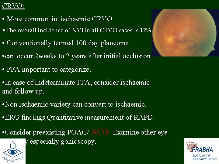 CRVO: • More common in ischaemic CRVO. • The overall incidence of NVI in