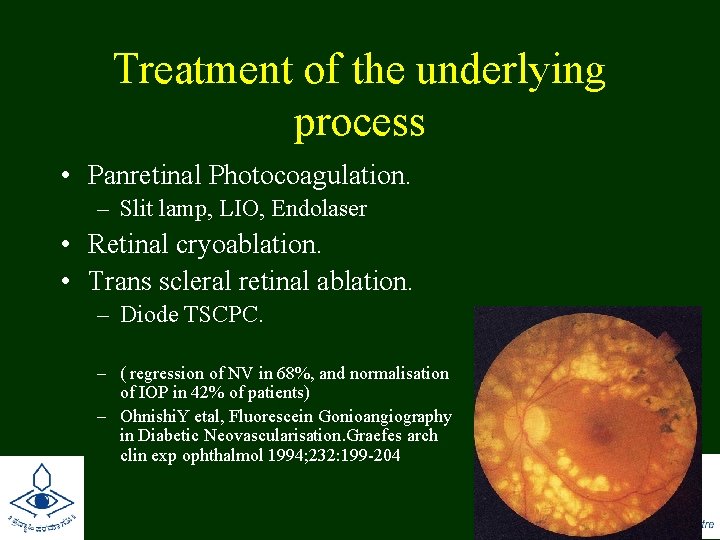 Treatment of the underlying process • Panretinal Photocoagulation. – Slit lamp, LIO, Endolaser •