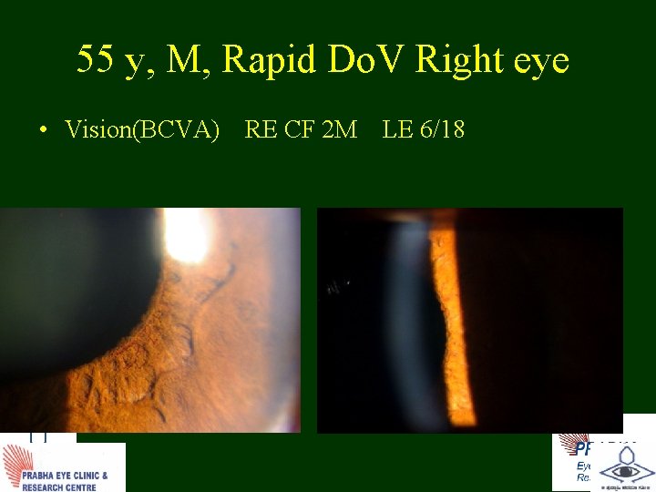 55 y, M, Rapid Do. V Right eye • Vision(BCVA) RE CF 2 M