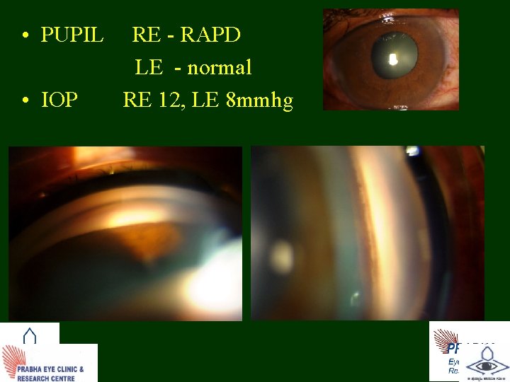  • PUPIL RE - RAPD LE - normal • IOP RE 12, LE