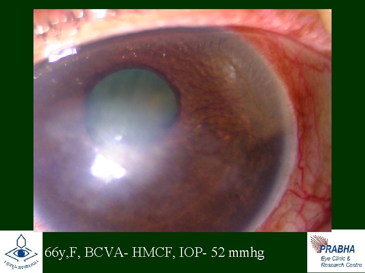  • 66 y, F, BCVA- HMCF, IOP- 52 mmhg 