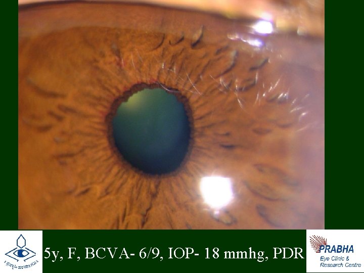  • 65 y, F, BCVA- 6/9, IOP- 18 mmhg, PDR 