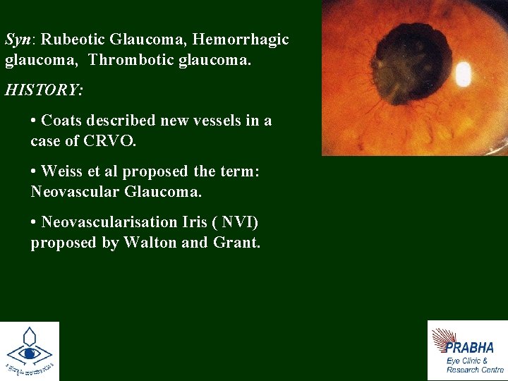 Syn: Rubeotic Glaucoma, Hemorrhagic glaucoma, Thrombotic glaucoma. HISTORY: • Coats described new vessels in
