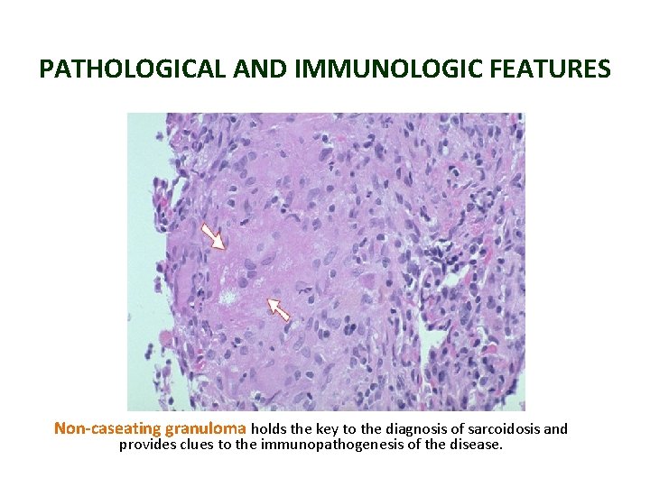 PATHOLOGICAL AND IMMUNOLOGIC FEATURES Non-caseating granuloma holds the key to the diagnosis of sarcoidosis