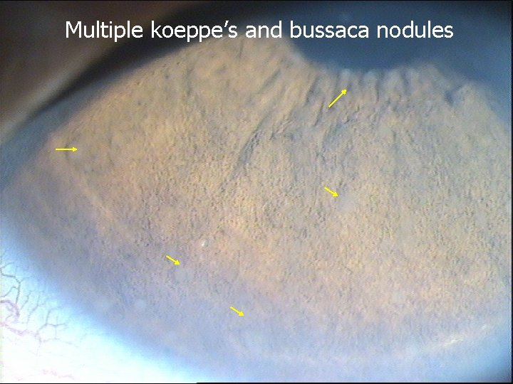 Multiple koeppe’s and bussaca nodules 