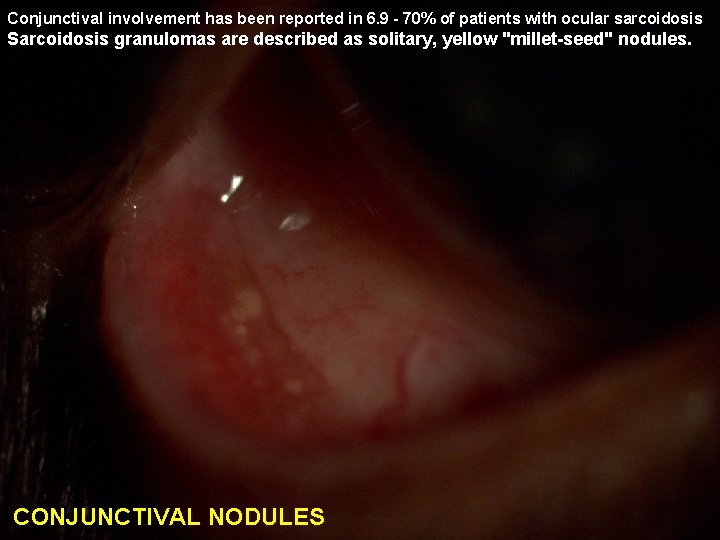 Conjunctival involvement has been reported in 6. 9 - 70% of patients with ocular