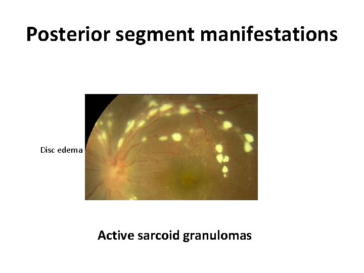 Posterior segment manifestations Disc edema Active sarcoid granulomas 