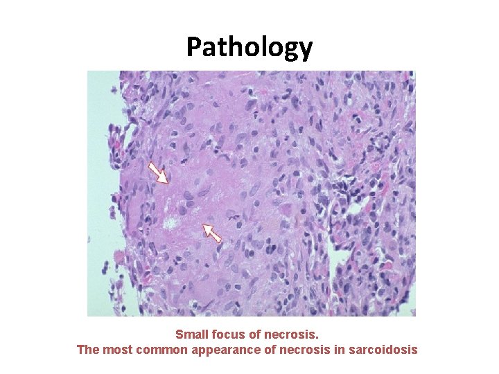 Pathology Small focus of necrosis. The most common appearance of necrosis in sarcoidosis 