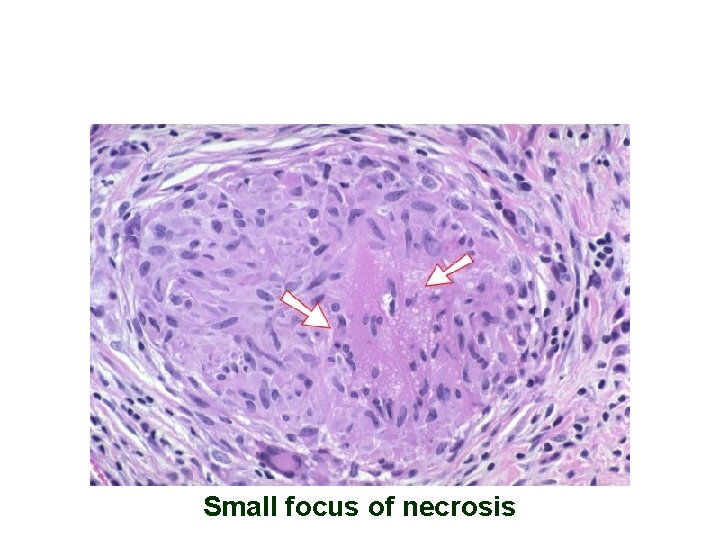 Small focus of necrosis 