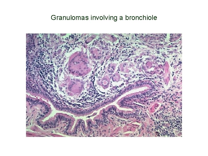 Granulomas involving a bronchiole 