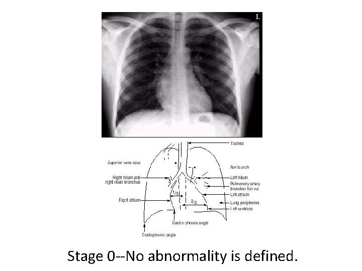 Stage 0 --No abnormality is defined. 