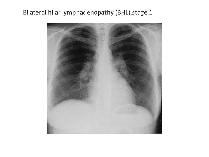 Bilateral hilar lymphadenopathy (BHL), stage 1 