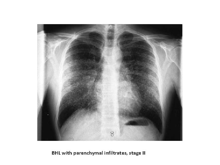 BHL with parenchymal infiltrates, stage II 