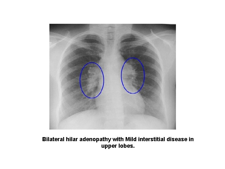 Bilateral hilar adenopathy with Mild interstitial disease in upper lobes. 