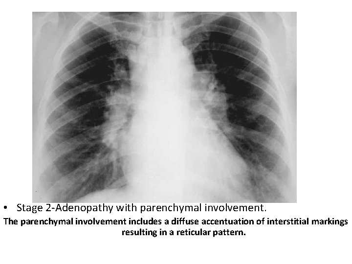  • Stage 2 -Adenopathy with parenchymal involvement. The parenchymal involvement includes a diffuse