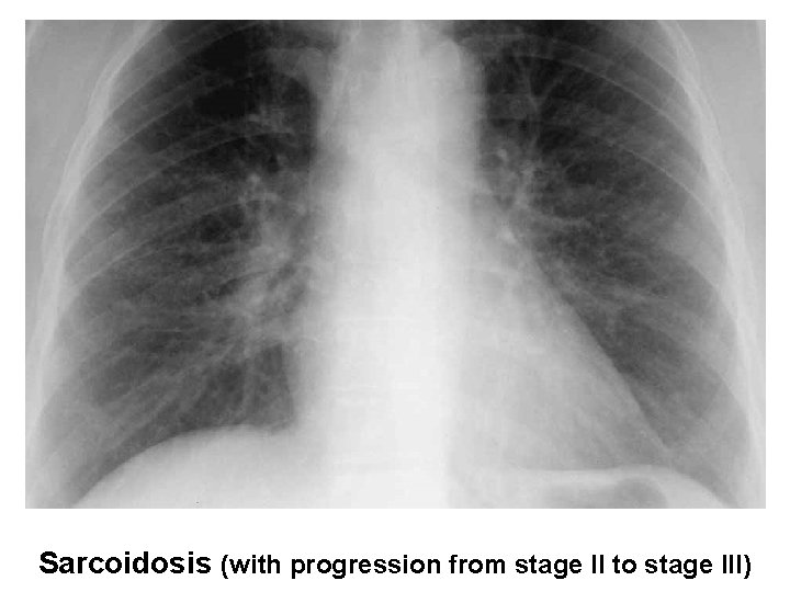 Sarcoidosis (with progression from stage II to stage III) 