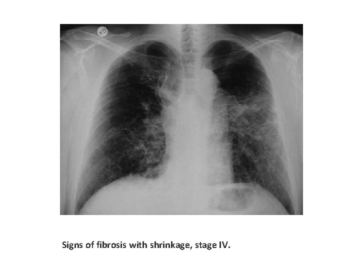 Signs of fibrosis with shrinkage, stage IV. 