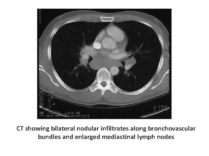 CT showing bilateral nodular infiltrates along bronchovascular bundles and enlarged mediastinal lymph nodes 