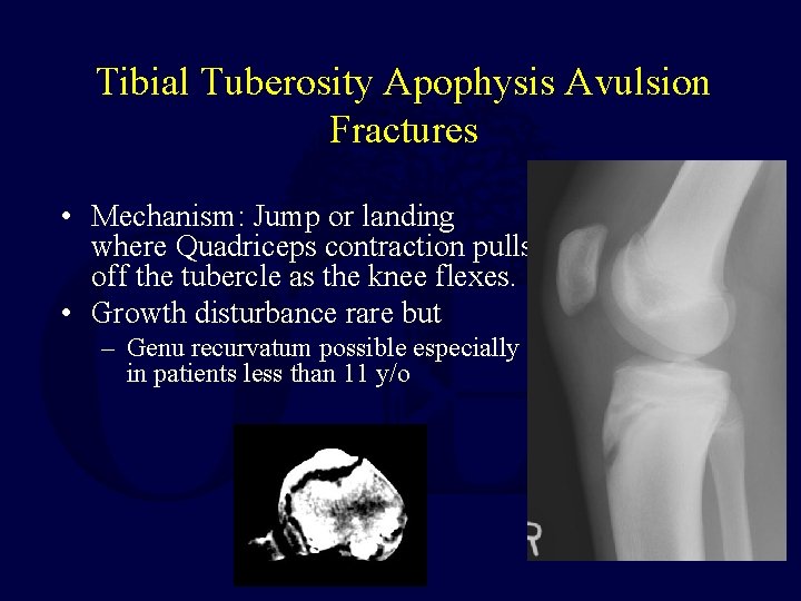 Tibial Tuberosity Apophysis Avulsion Fractures • Mechanism: Jump or landing where Quadriceps contraction pulls