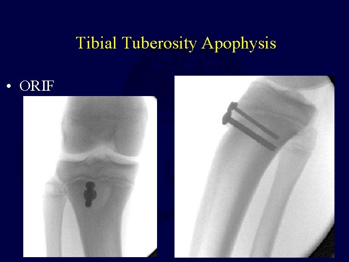 Tibial Tuberosity Apophysis • ORIF 