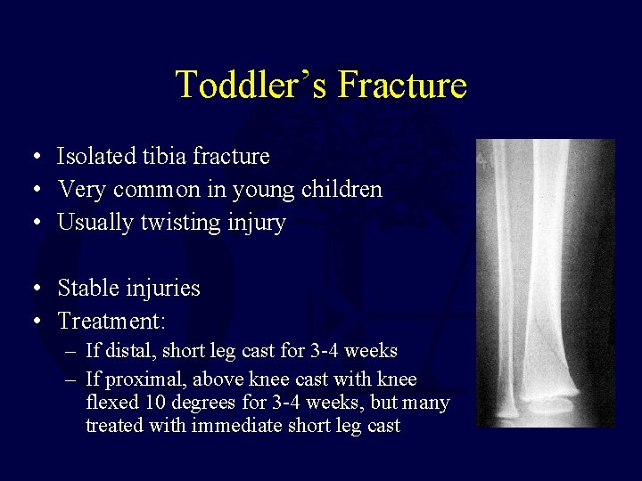 Toddler’s Fracture • Isolated tibia fracture • Very common in young children • Usually