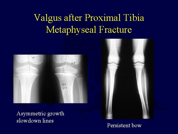 Valgus after Proximal Tibia Metaphyseal Fracture Asymmetric growth slowdown lines Persistent bow 