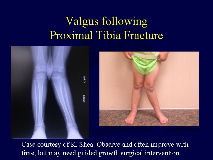 Valgus following Proximal Tibia Fracture Case courtesy of K. Shea. Observe and often improve