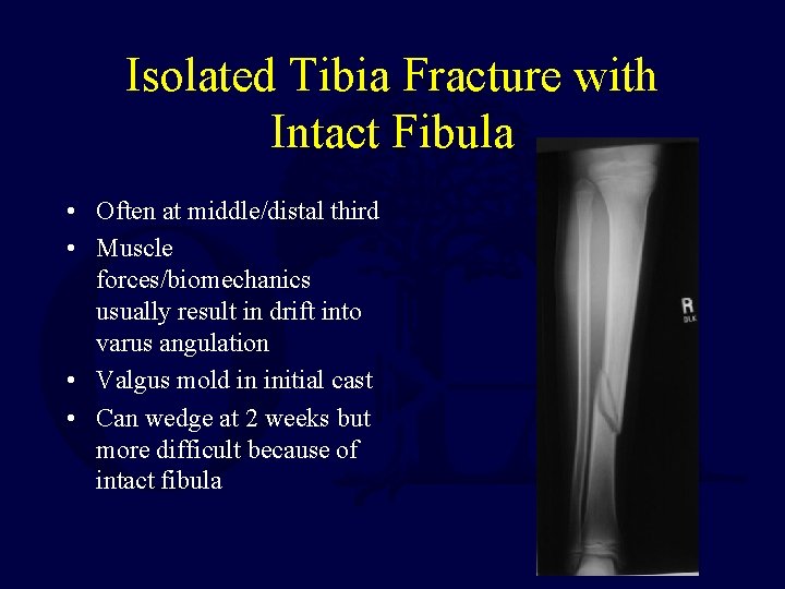 Isolated Tibia Fracture with Intact Fibula • Often at middle/distal third • Muscle forces/biomechanics