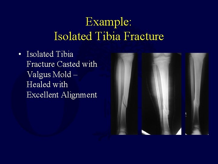 Example: Isolated Tibia Fracture • Isolated Tibia Fracture Casted with Valgus Mold – Healed