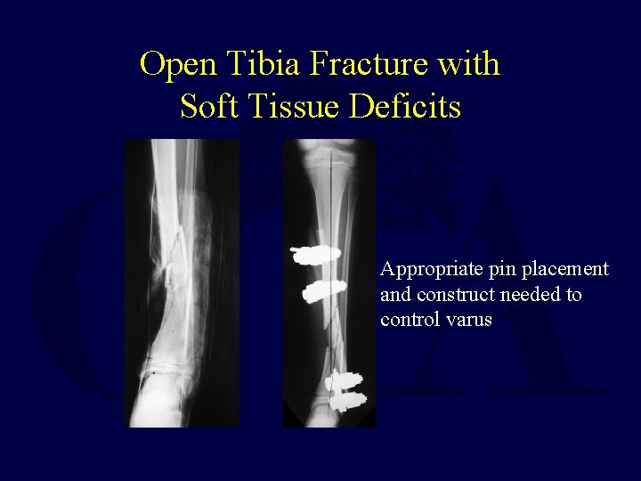 Open Tibia Fracture with Soft Tissue Deficits Appropriate pin placement and construct needed to