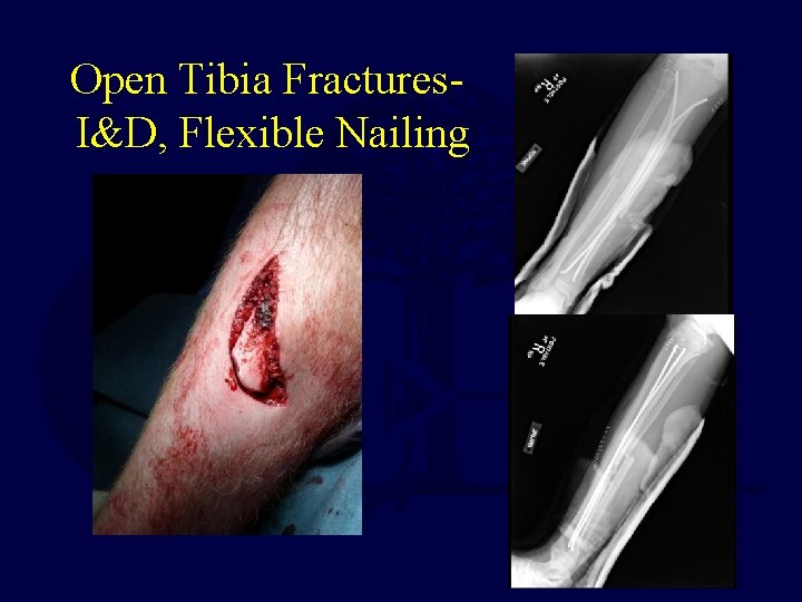 Open Tibia Fractures. I&D, Flexible Nailing 