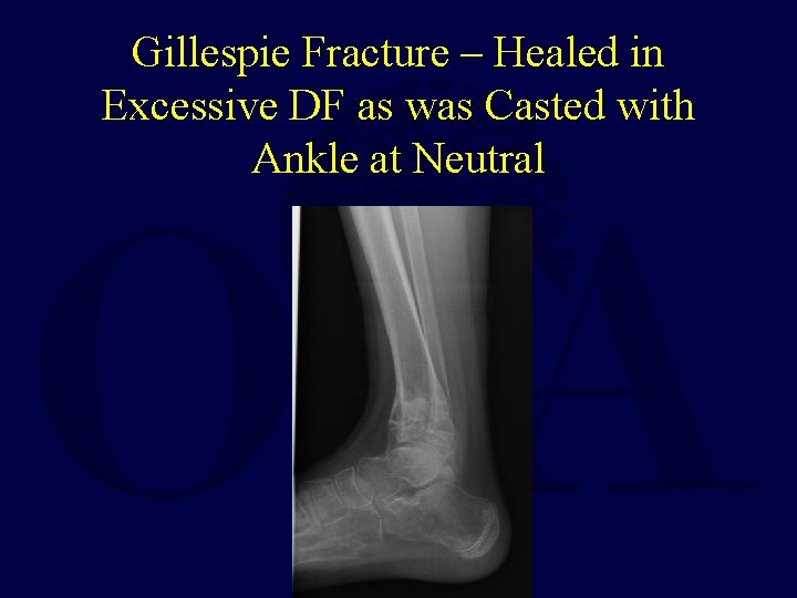 Gillespie Fracture – Healed in Excessive DF as was Casted with Ankle at Neutral