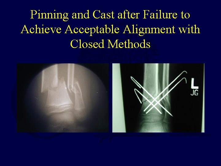 Pinning and Cast after Failure to Achieve Acceptable Alignment with Closed Methods 