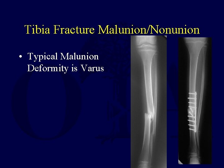 Tibia Fracture Malunion/Nonunion • Typical Malunion Deformity is Varus 