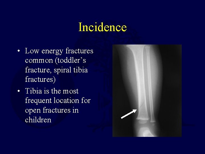 Incidence • Low energy fractures common (toddler’s fracture, spiral tibia fractures) • Tibia is