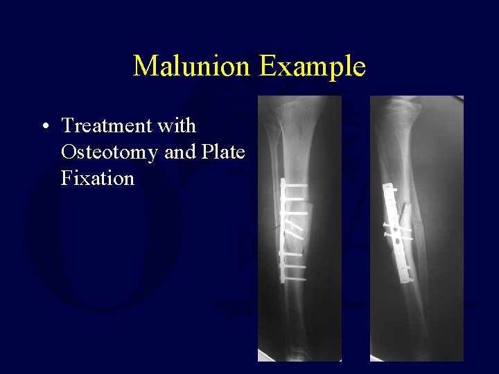 Malunion Example • Treatment with Osteotomy and Plate Fixation 