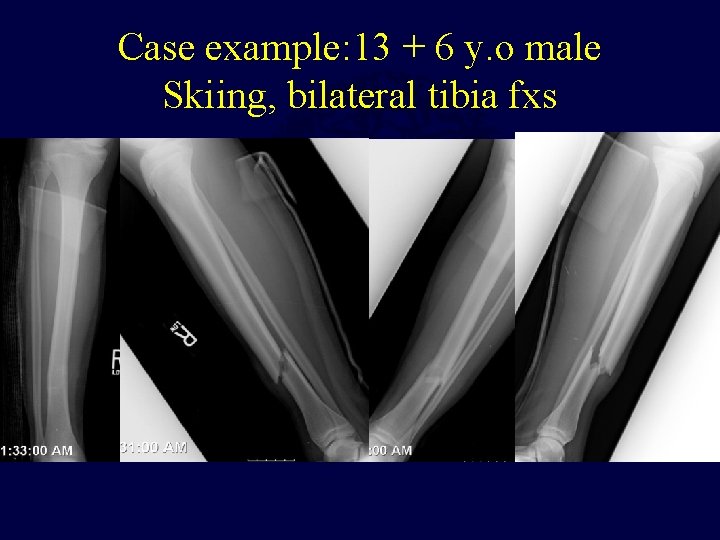 Case example: 13 + 6 y. o male Skiing, bilateral tibia fxs 