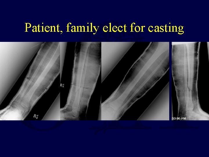 Patient, family elect for casting 