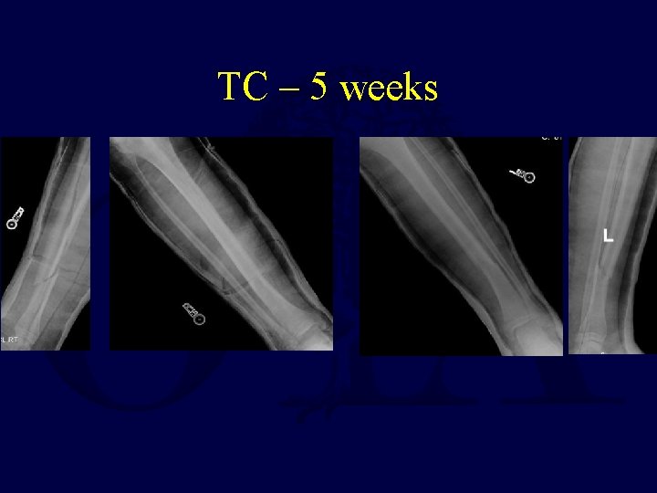 TC – 5 weeks 