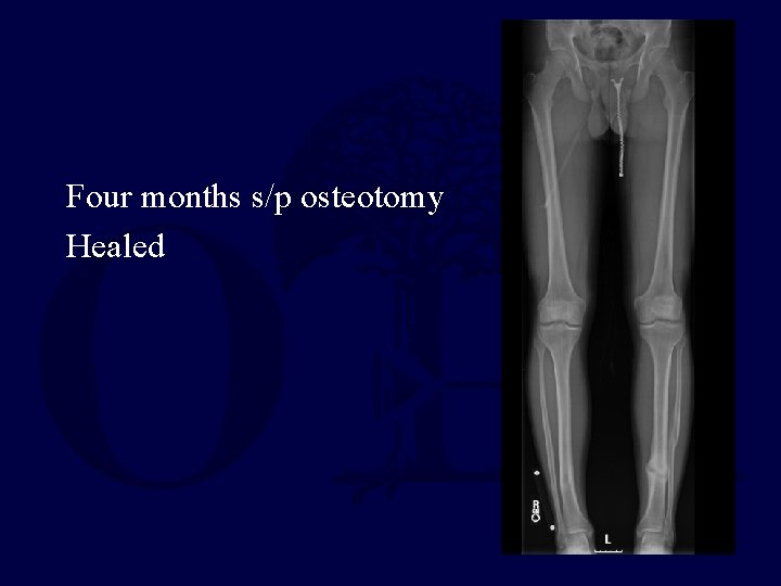 Four months s/p osteotomy Healed 