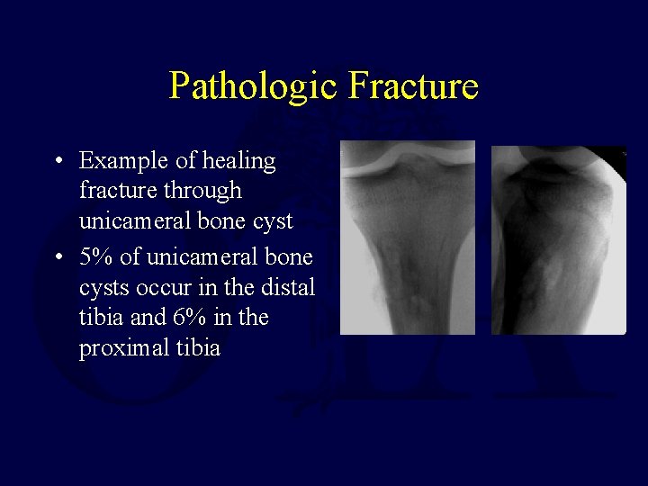 Pathologic Fracture • Example of healing fracture through unicameral bone cyst • 5% of